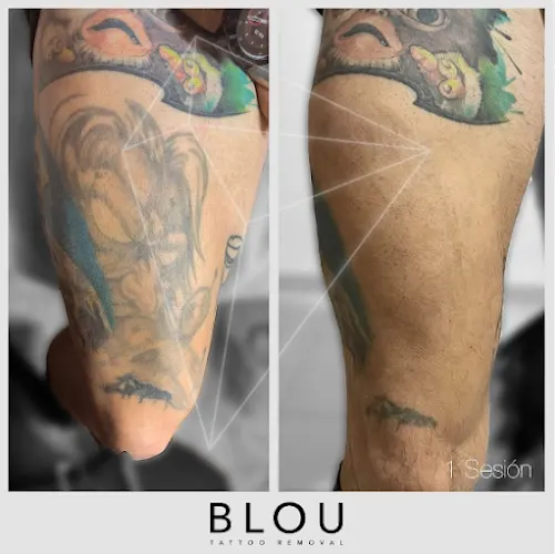 Blou Tattoo Removal Madrid